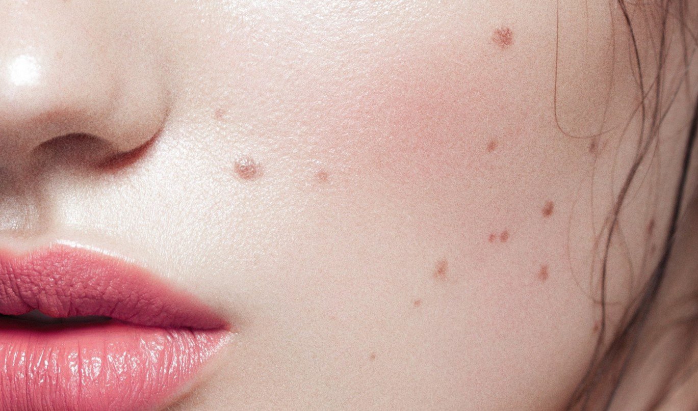 Beauty marks and moles what you need to know?